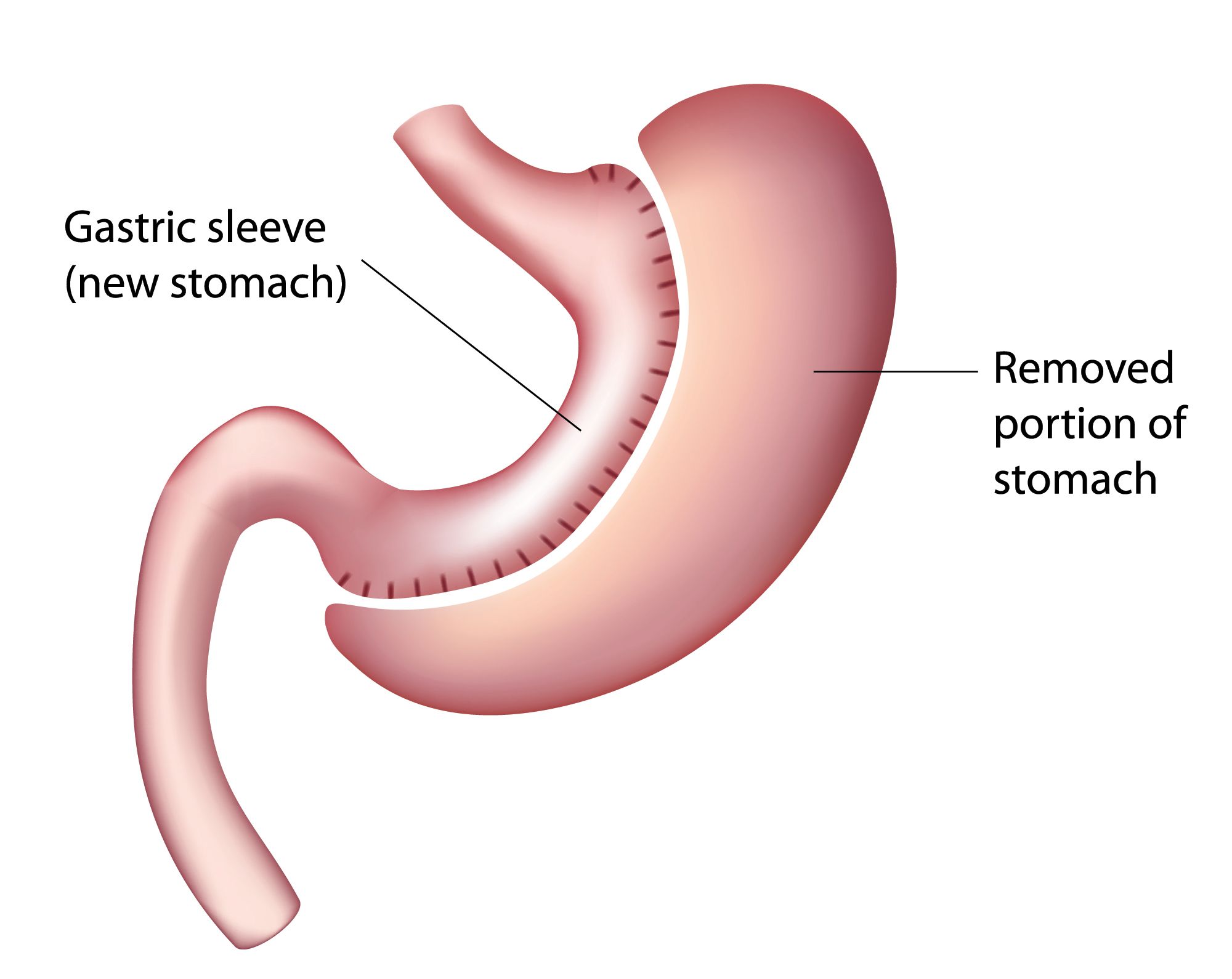 Gastric sleeve surgery Under Turkish Platforms
