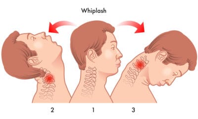 The Journey from Whiplash to No Whiplash – A Chiropractic Treatment for the Common Whiplash