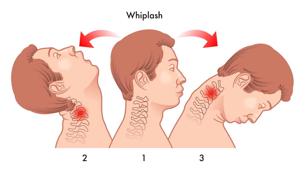 The Journey from Whiplash to No Whiplash – A Chiropractic Treatment for the Common Whiplash