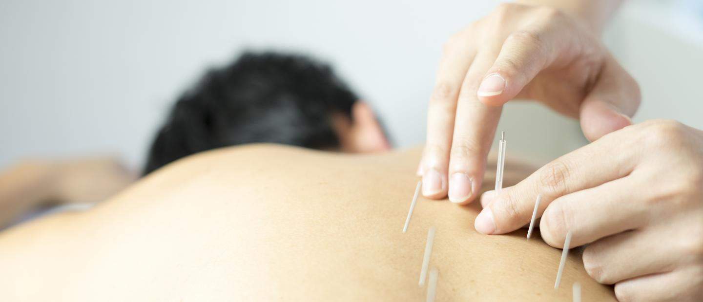 What is acupuncture? Benefits of how it works, side effects