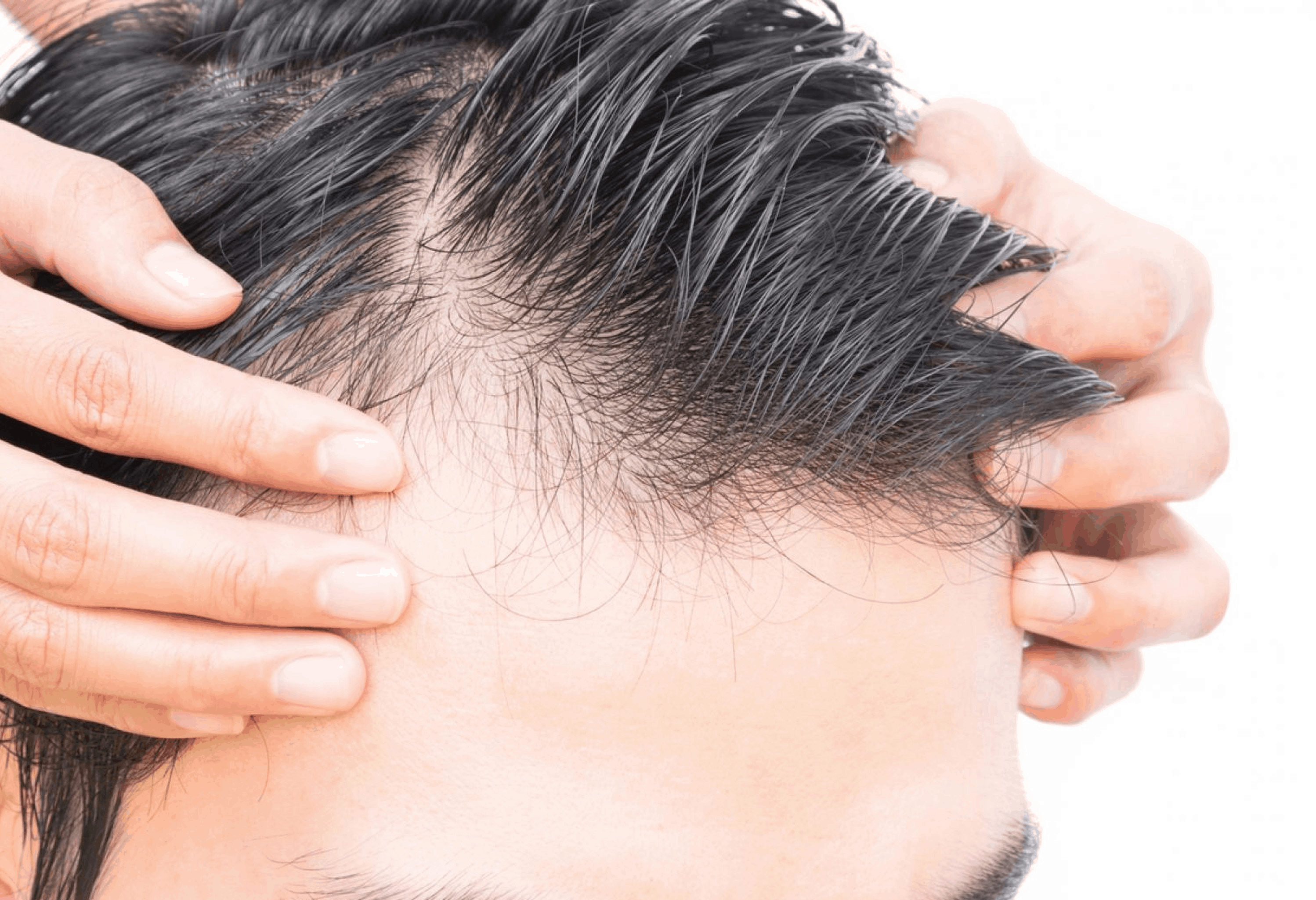 You Might be Causing Your Own Baldness