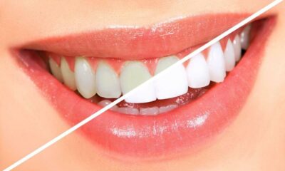 What Are Take-Home Kits from Teeth Whitening Mandurah?