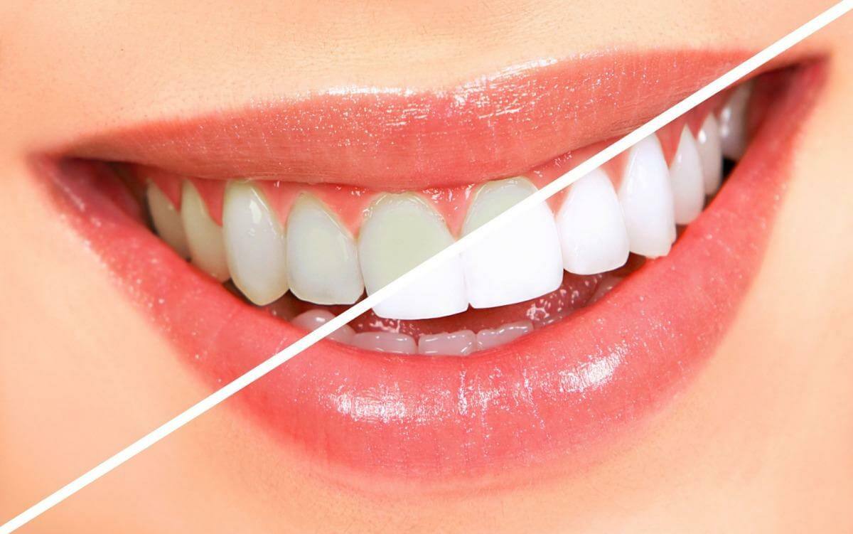What Are Take-Home Kits from Teeth Whitening Mandurah?