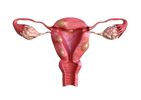 Mystery of Fibroids!