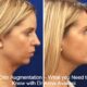 Chin Augmentation – What you Need to Know with Dr Anna Avaliani
