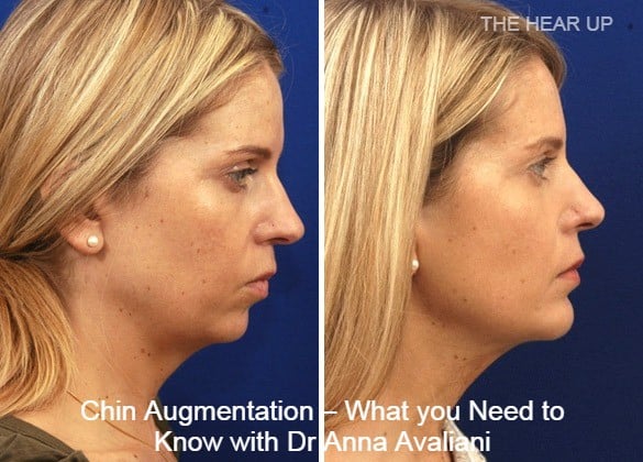 Chin Augmentation – What you Need to Know with Dr Anna Avaliani