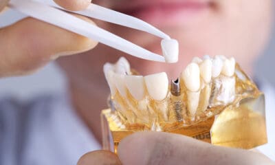 The risks of dental implant procedures