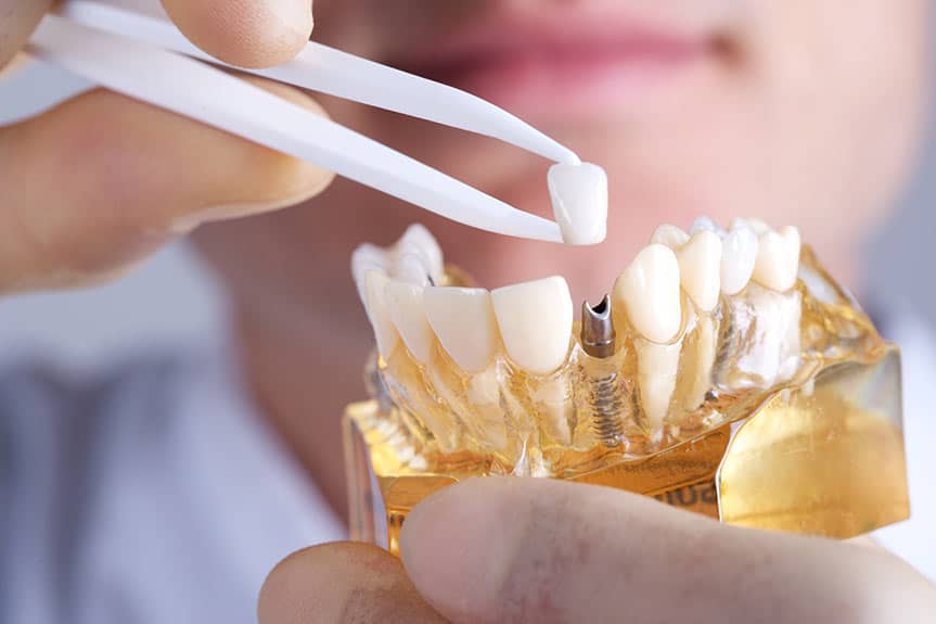 The risks of dental implant procedures