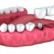 All You Need to Know About Denture Implants