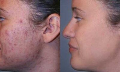 MICRODERMABRASION FOR Acne SCARS