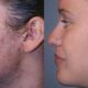 MICRODERMABRASION FOR Acne SCARS
