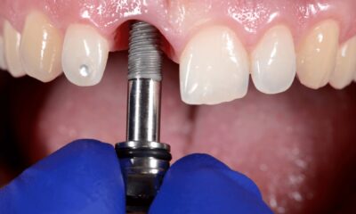 What You Need to Know About Dental Implants?