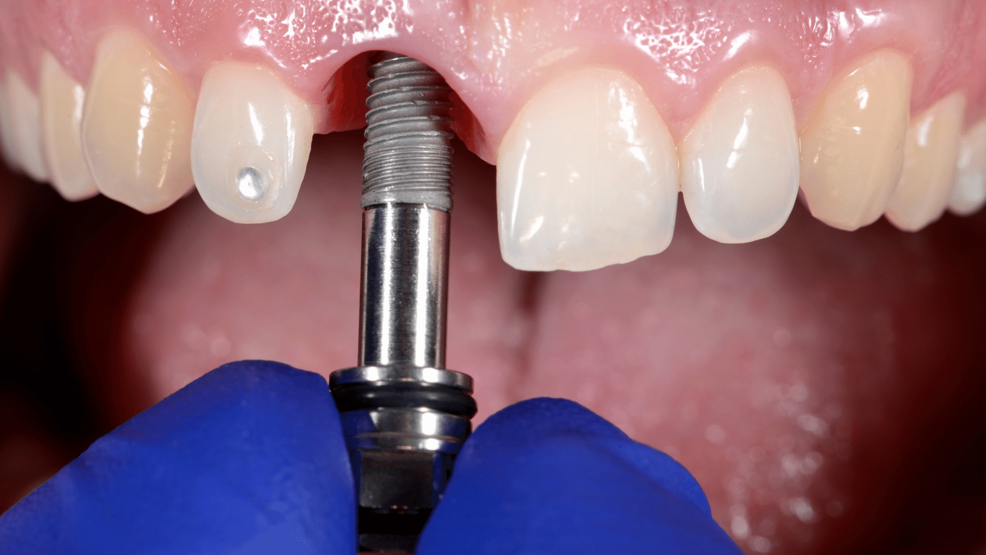 What You Need to Know About Dental Implants?