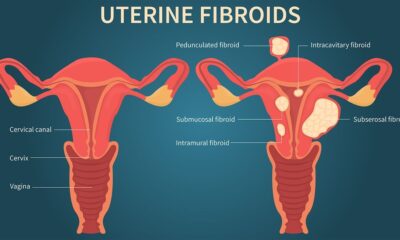 Uterine Fibroids – Demystifying the Top Myths