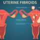 Uterine Fibroids – Demystifying the Top Myths
