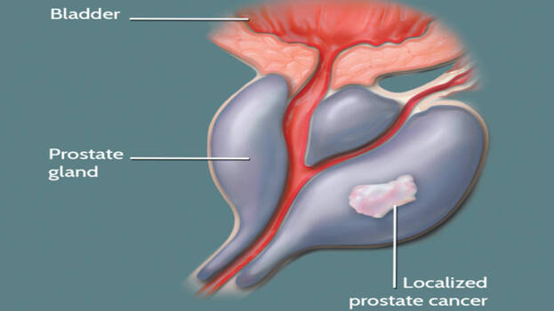 What Diseases or Conditions Can Affect the Prostate?
