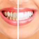 What to Expect from Teeth Whitening?