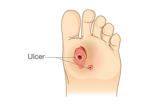 All You Need To Know About Foot Ulcers