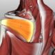 Myths and Misconceptions of Rotator Cuff Tear