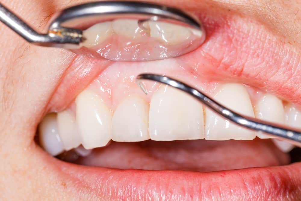 Gum Disease Prevention Tips