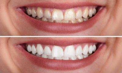 How Do I Choose The Right Teeth Whitening Dentist?