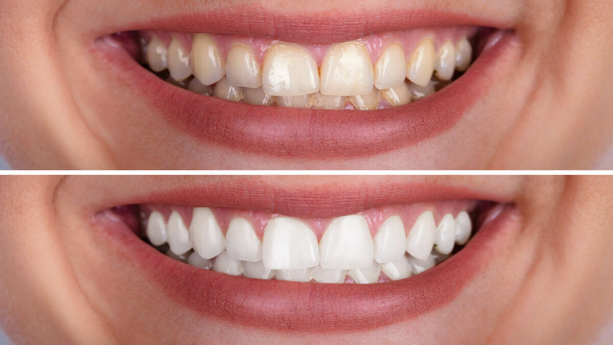 How Do I Choose The Right Teeth Whitening Dentist?