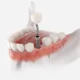 Dental Implants In Perth: How They Can Help You