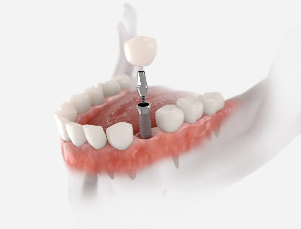 Dental Implants In Perth: How They Can Help You