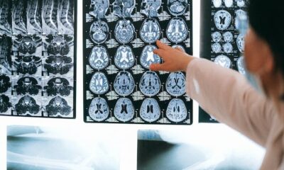 5 Benefits of Transcranial Magnetic Stimulation