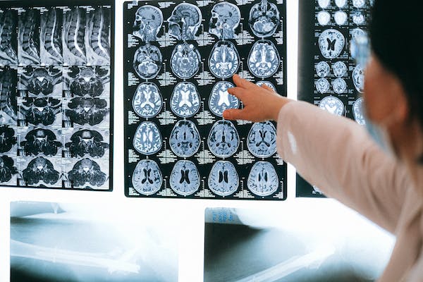 5 Benefits of Transcranial Magnetic Stimulation