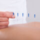 How does acupuncture work? All you need to know