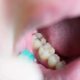 Early Signs of Cavities in Teeth and How to Treat Them