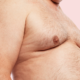 Gynecomastia Surgery and Cost in Lahore At Dr. Atta's Clinic