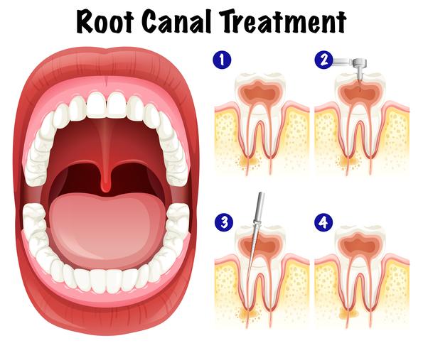 dental-vector-of-root-canal-treatment