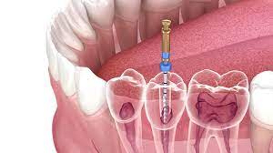 Explain in detail the root canal process by Dentist Lilyfield