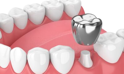 The Importance of Tooth Crowns: Enhancing Dental Health and Restoring Smiles