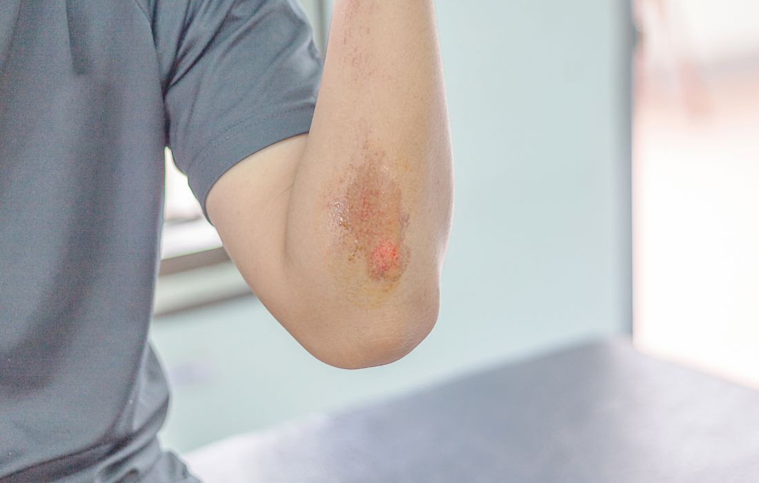 How To Speed Wound Healing?