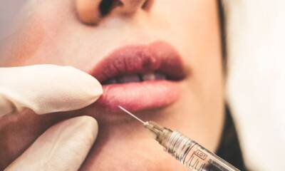 Lip Filler Safety and Myths: Separating Fact from Fiction