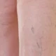 What Are the Stages of Varicose Veins?