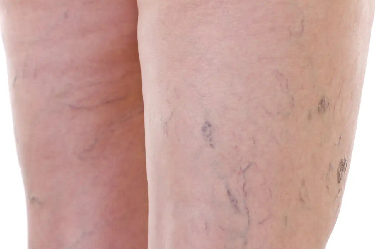 What Are the Stages of Varicose Veins?