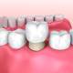Guide to Dental Crowns