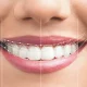 Smile Design Dentistry Service: Enhancing Your Smile Aesthetically and Functionally