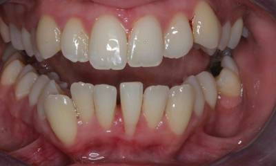 The Power of Orthodontics: A Look at the Crooked Teeth Before and After Treatment