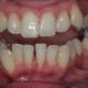 The Power of Orthodontics: A Look at the Crooked Teeth Before and After Treatment