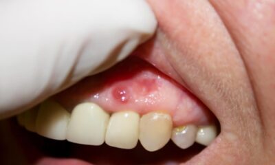 Doxycycline and Dental Health: Using Antibiotics for Oral Infections