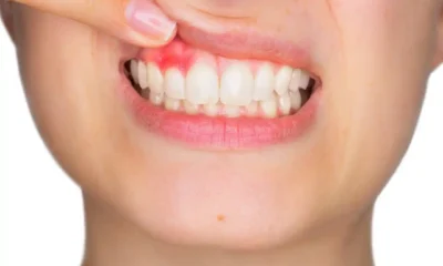 Gum Rejuvenation: How Periodontal Services Can Restore Your Smile