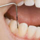 The Power of Deep Teeth Cleaning: How It Can Improve Your Oral Health