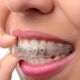 Achieving a Perfect Smile: How Clear Aligners are Transforming Chicago Smiles