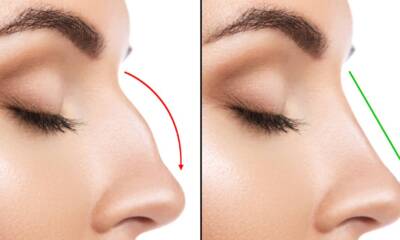 What to Expect: The Recovery Process of Rhinoplasty Before and After Surgery