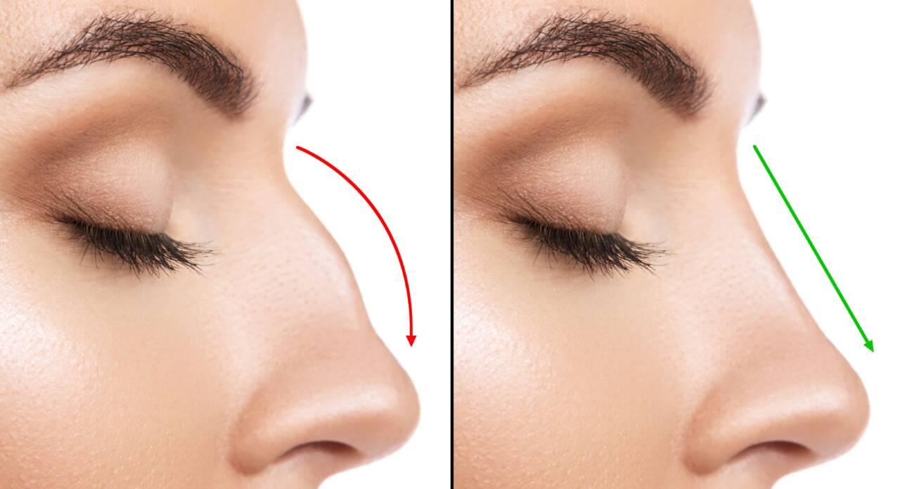 What to Expect: The Recovery Process of Rhinoplasty Before and After Surgery